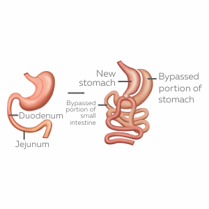 About Asian Bariatrics
