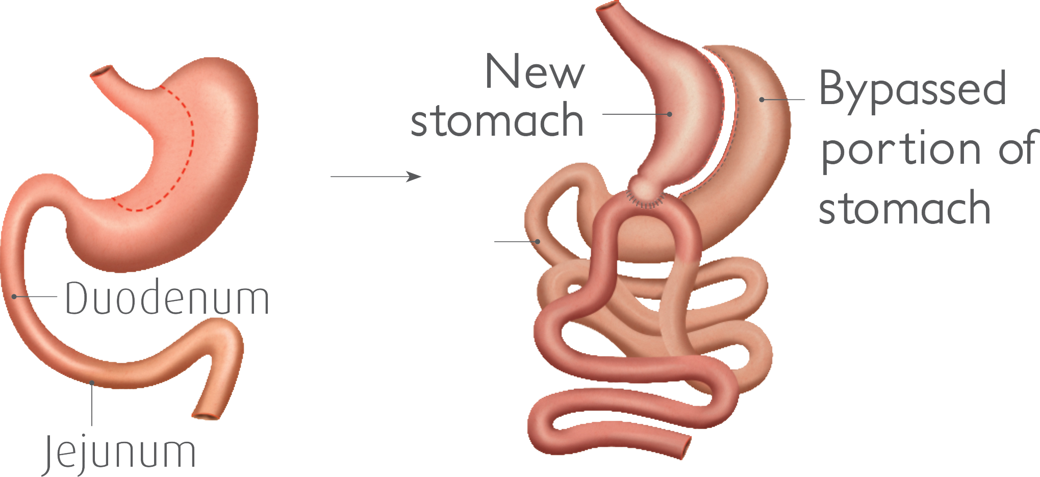 Gastric Bypass Weight Loss: Essential Guide, Chart and Timeline